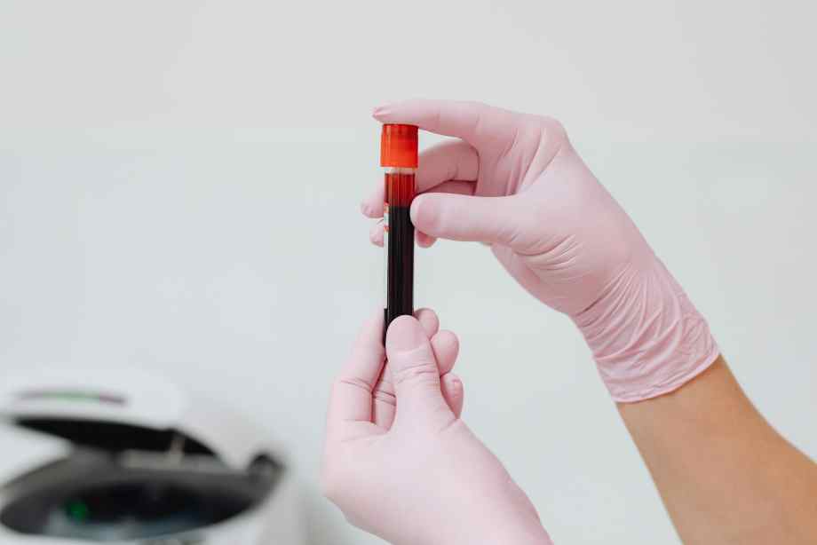 découvrez les liens entre le taux de crp et le cancer du foie en 2025, les avancées médicales et les perspectives de traitement.