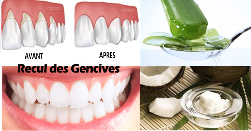 découvrez des méthodes naturelles efficaces pour dégonfler vos gencives rapidement et soulager les inflammations sans médicament.